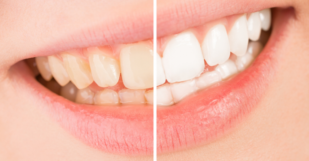 השתלות שיניים ברמת גן